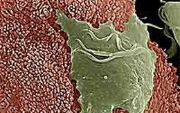 Phụ nữ nhiễm trùng roi có thể vô sinh